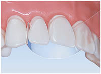 Mylar Strips