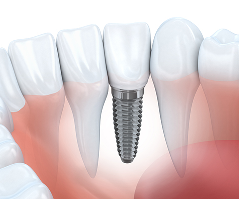 Implant Products